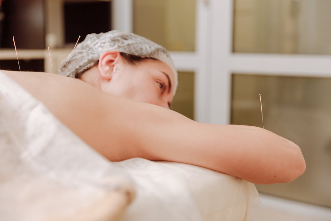 Free Woman With Acupuncture Needles Lying Down Stock Photo