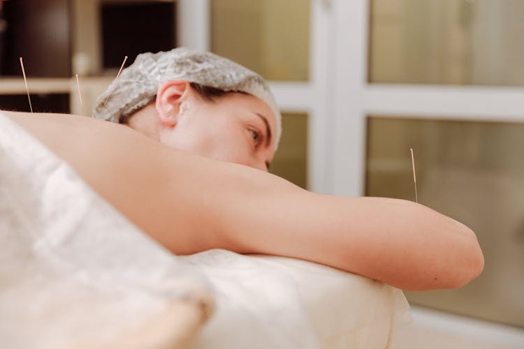 Woman With Acupuncture Needles Lying Down