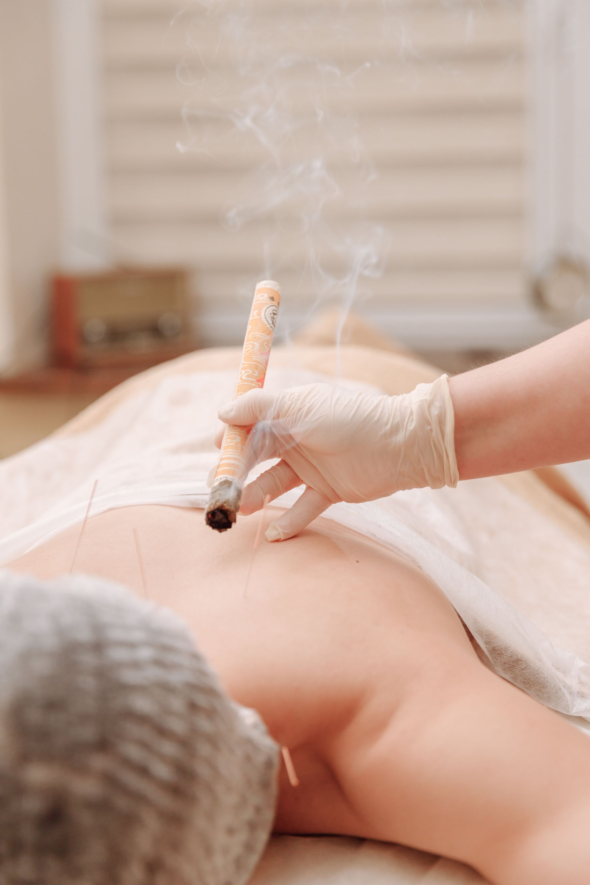 Practitioner holding a lit moxa stick above a patient's back during warming therapy