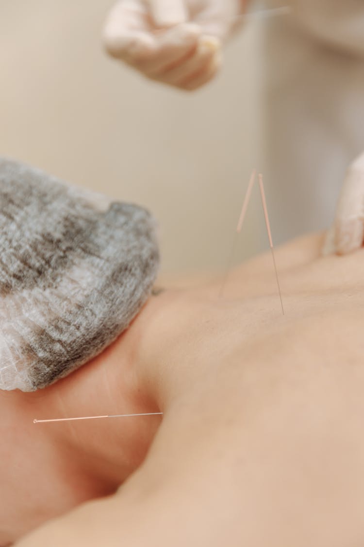 Person's Bare Back With Acupuncture Needles