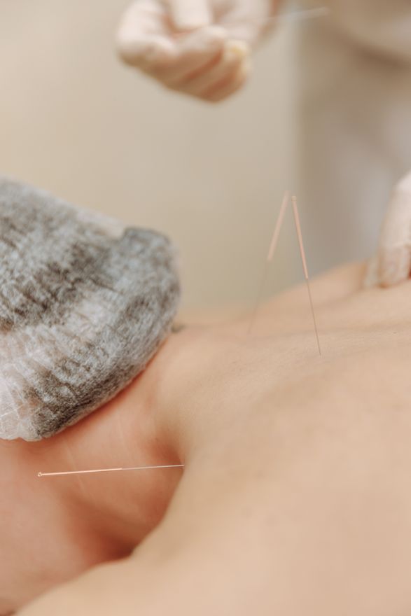 Acupuncture session at Wellness by Marusa
