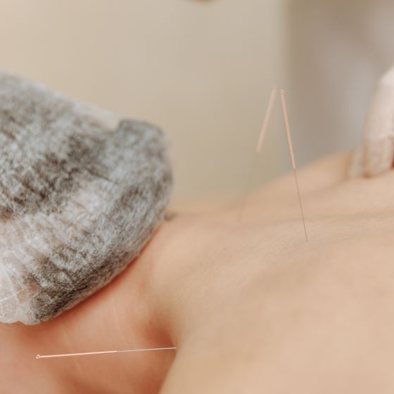 Acupuncture needles placed along the back