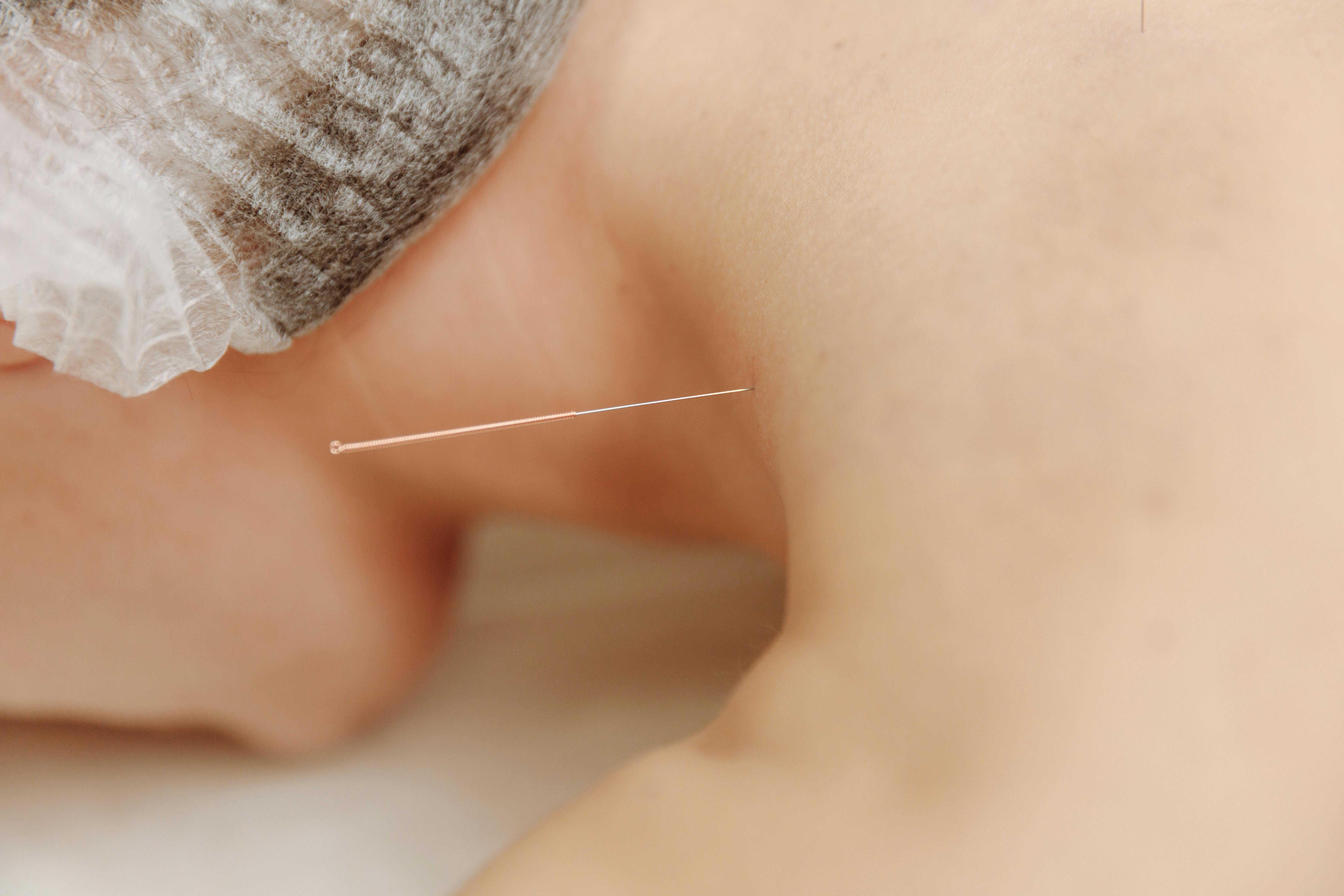 Acupuncture needle in patient shoulder representing meridian energy work