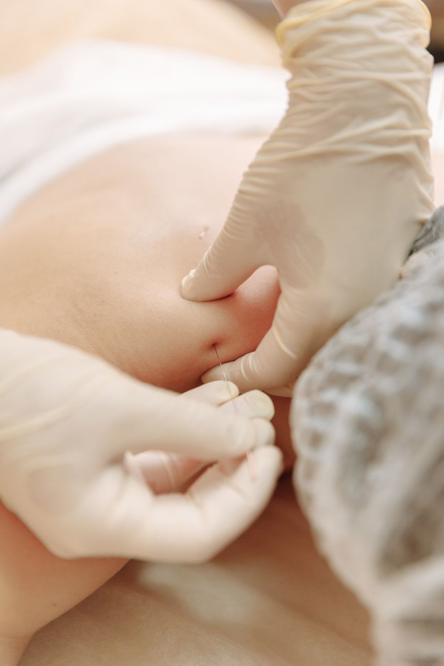 Dry needling trigger point therapy Seven Oaks Highland Creek Scarborough