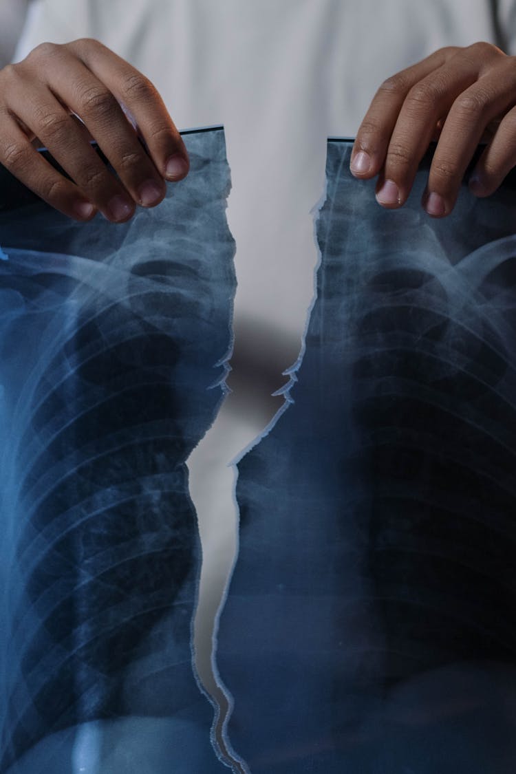 Person Holding A Torn  X-ray Result