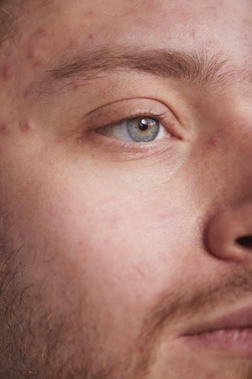 Kostnadsfria Kostnadsfri bild av acne, extrem närbild, finnar Stock foto