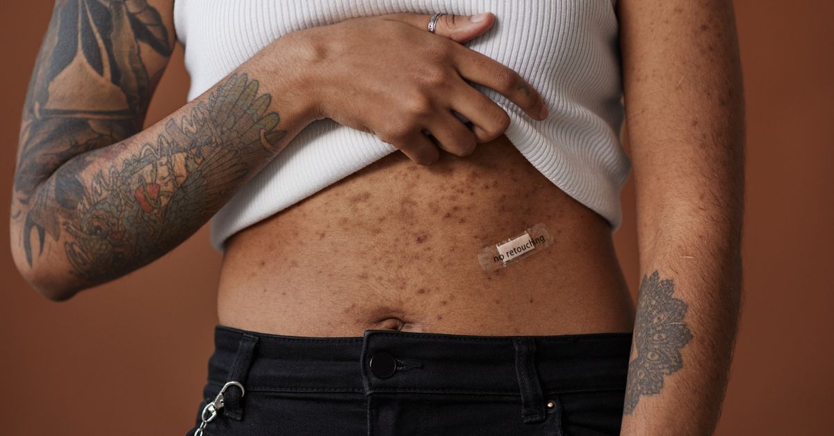 Psoriasis in the USA: Beyond Skin Deep Challenges