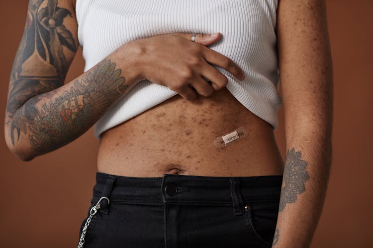 A Tattooed Person With Acne On Her Body