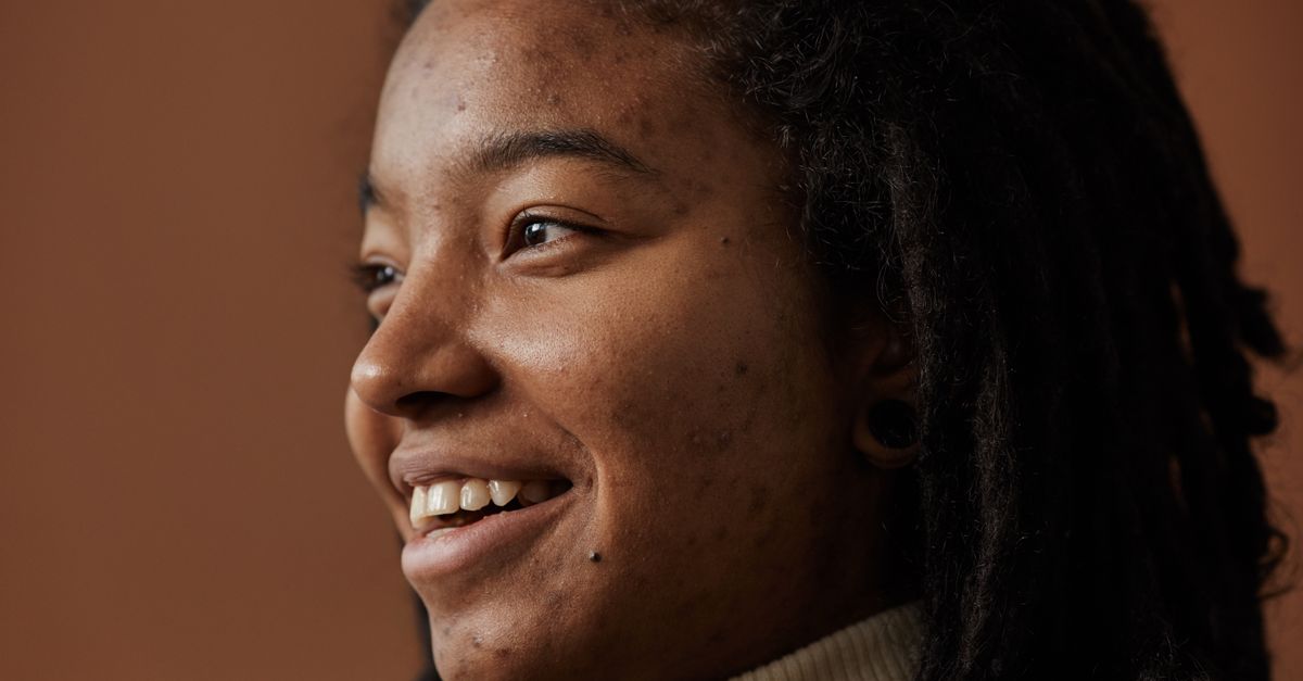 Why Does Acne Impact Self-Confidence