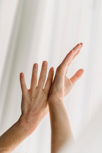 skin rash allergy hand