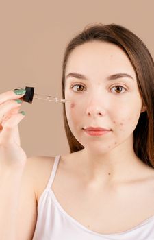 A young woman in a studio applying skincare serum to her face for acne treatment.