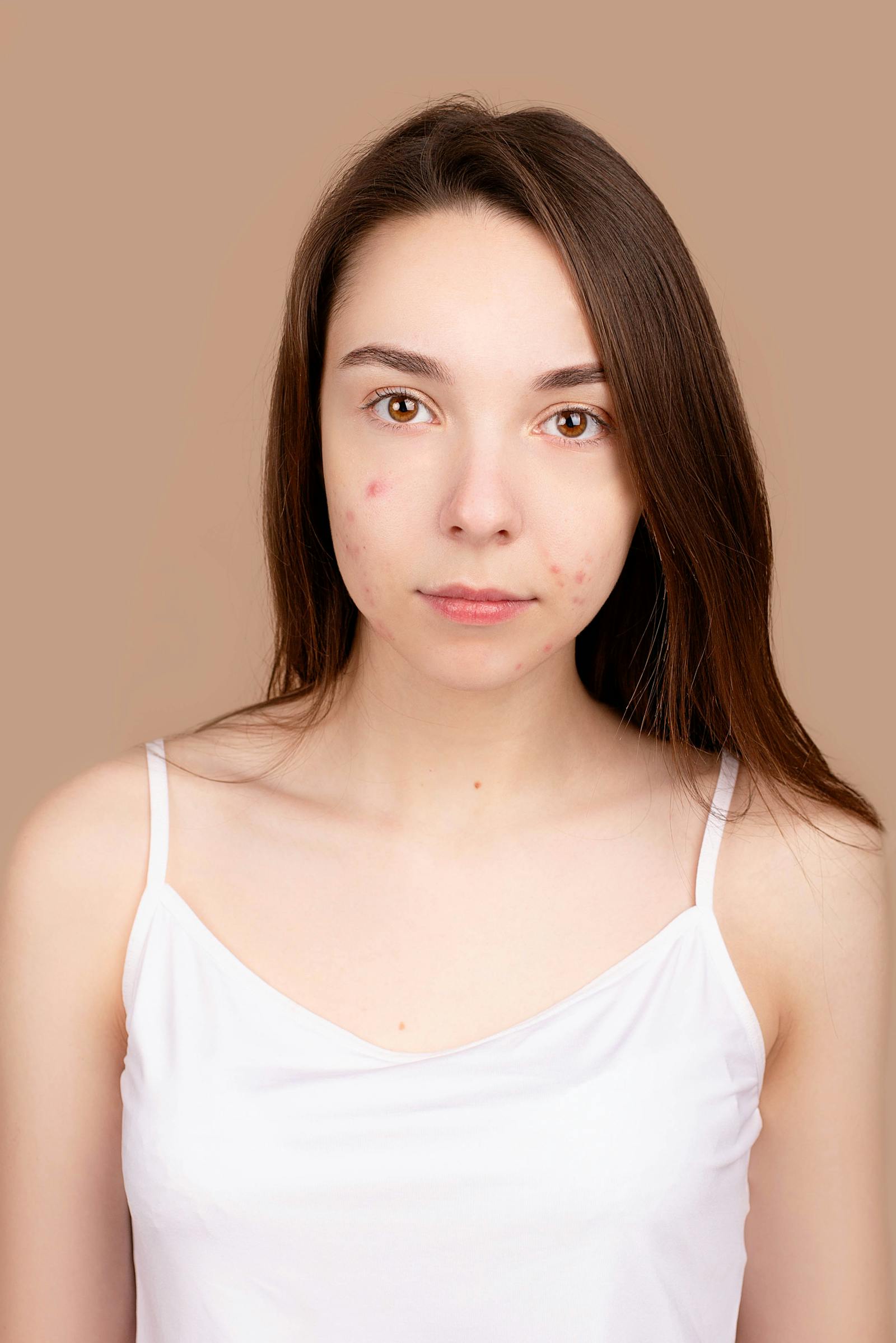 100+张最精彩的“Unsplash Pimple”图片 · 100免费下载 · Pexels素材图片