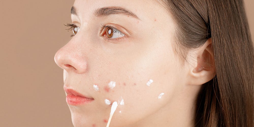 Workshop Phục Hồi Da Hư Tổn của ACNE STUDIO tại Rạch Giá