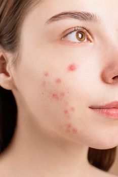 best skin care for hormonal acne