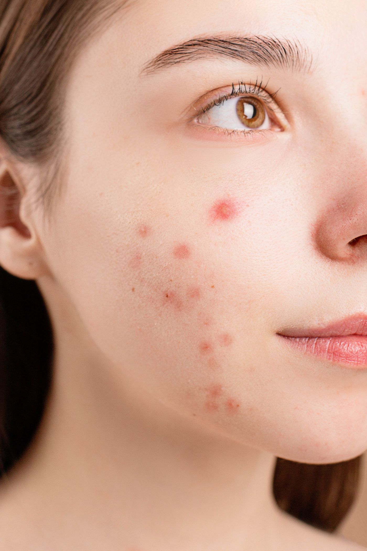 Illustrative close-up showing visible acne and natural skin texture
