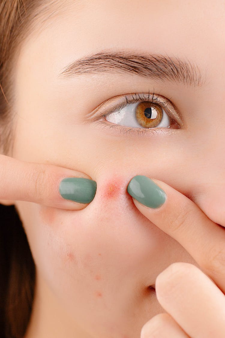 A Woman Pricking Her Pimple