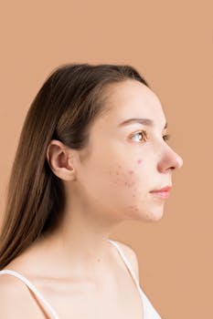 Close-up profile portrait of a teenage girl with acne against a neutral background.