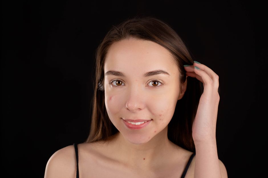 5 Dark Spot Myths Busted: Remove Acne Scars Permanently (2026)