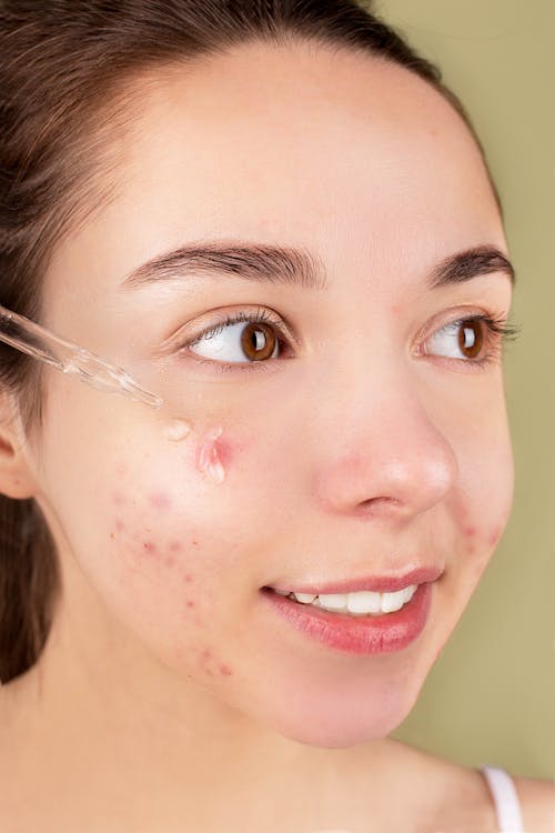 Free woman applying facial serum as an example of acne cures