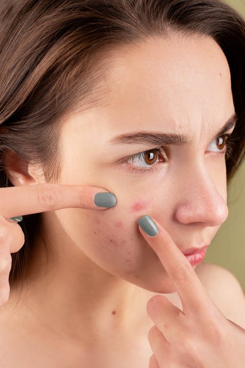 Free woman squeezing her pimples on how to cover up acne blog article page