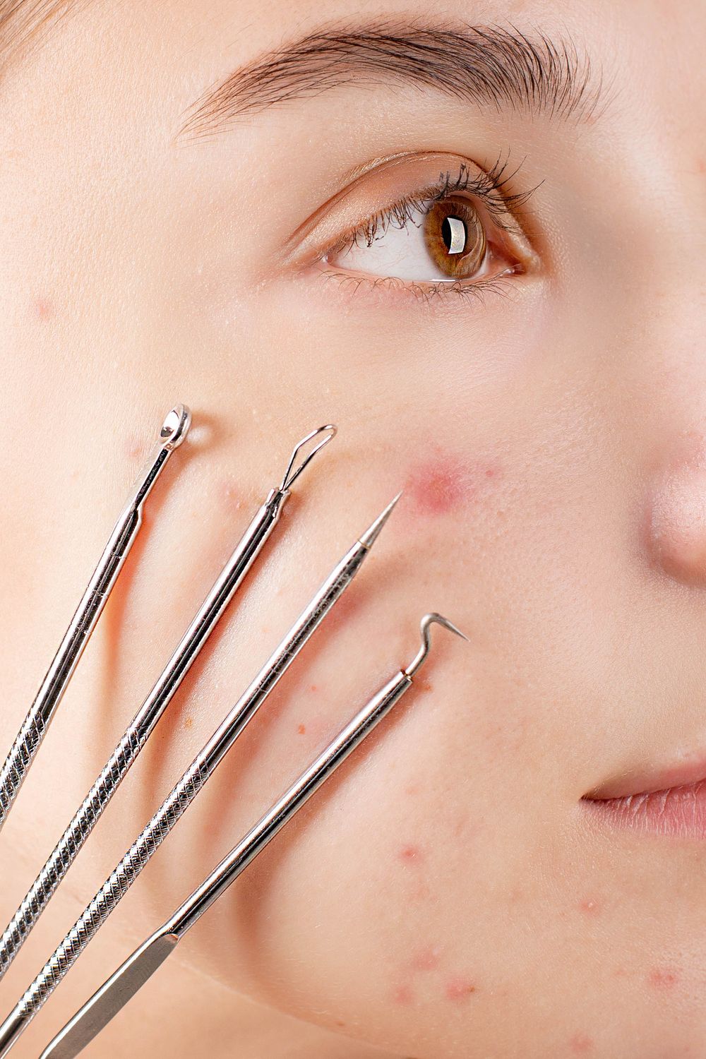 Clinical skin treatment for acne and scarring