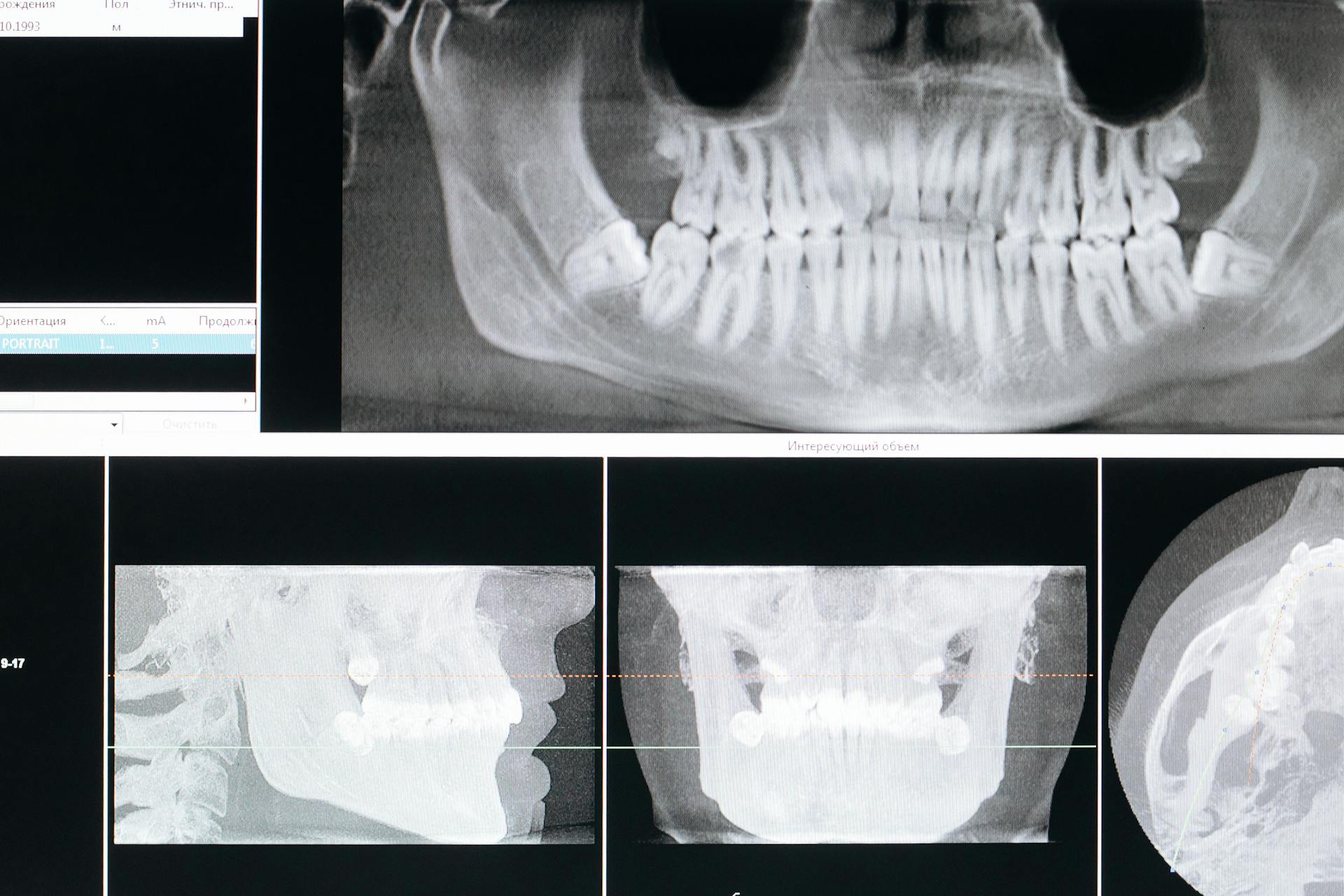 Close-Up Shot of Xray of Mouth