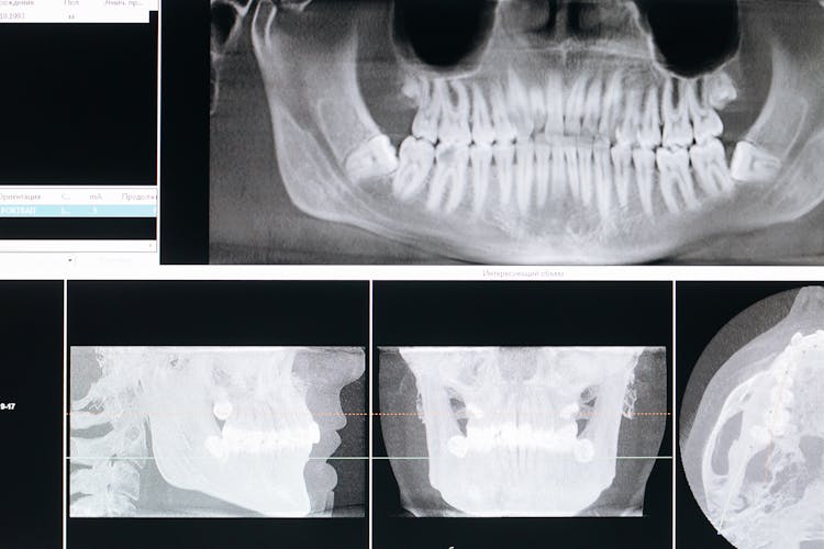 Close-Up Shot Of Xray Of Mouth