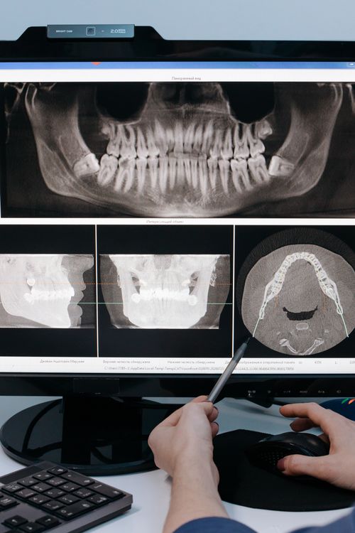 CBCT for Supernumerary and Impacted Teeth: 3D Localization Guide
