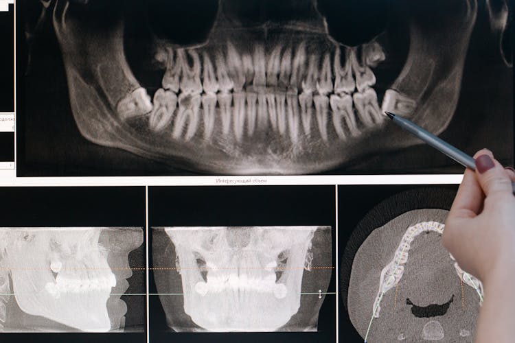 Close-Up Shot Of Xray Of Teeth