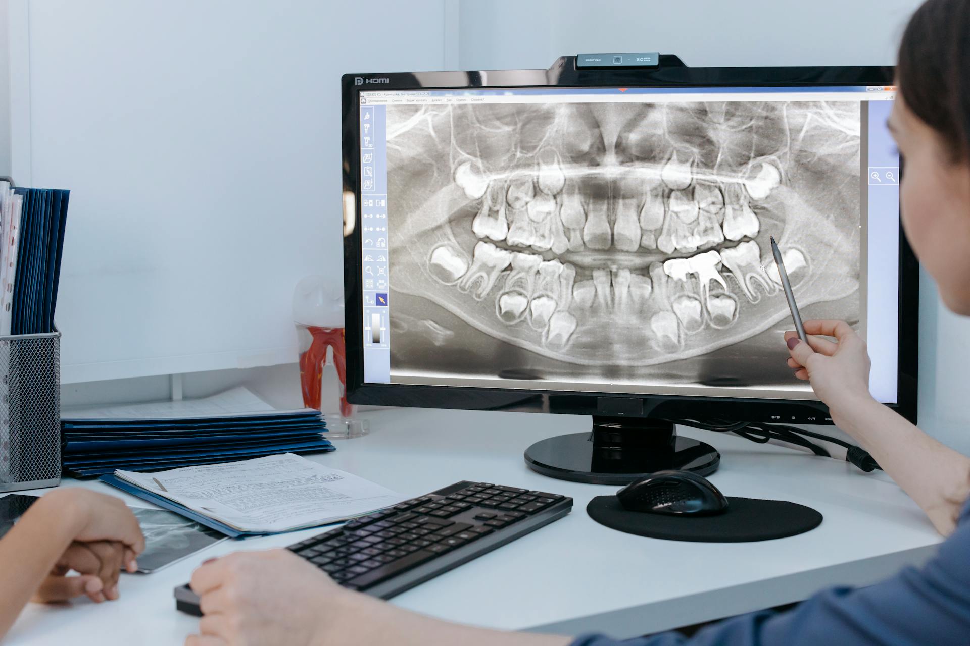 Close-Up Shot of a Person Pointing at the Xray Image on the Computer Screen