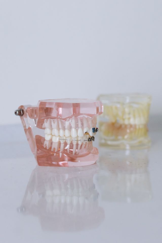 Overdenture on Lucitone with ball attachment