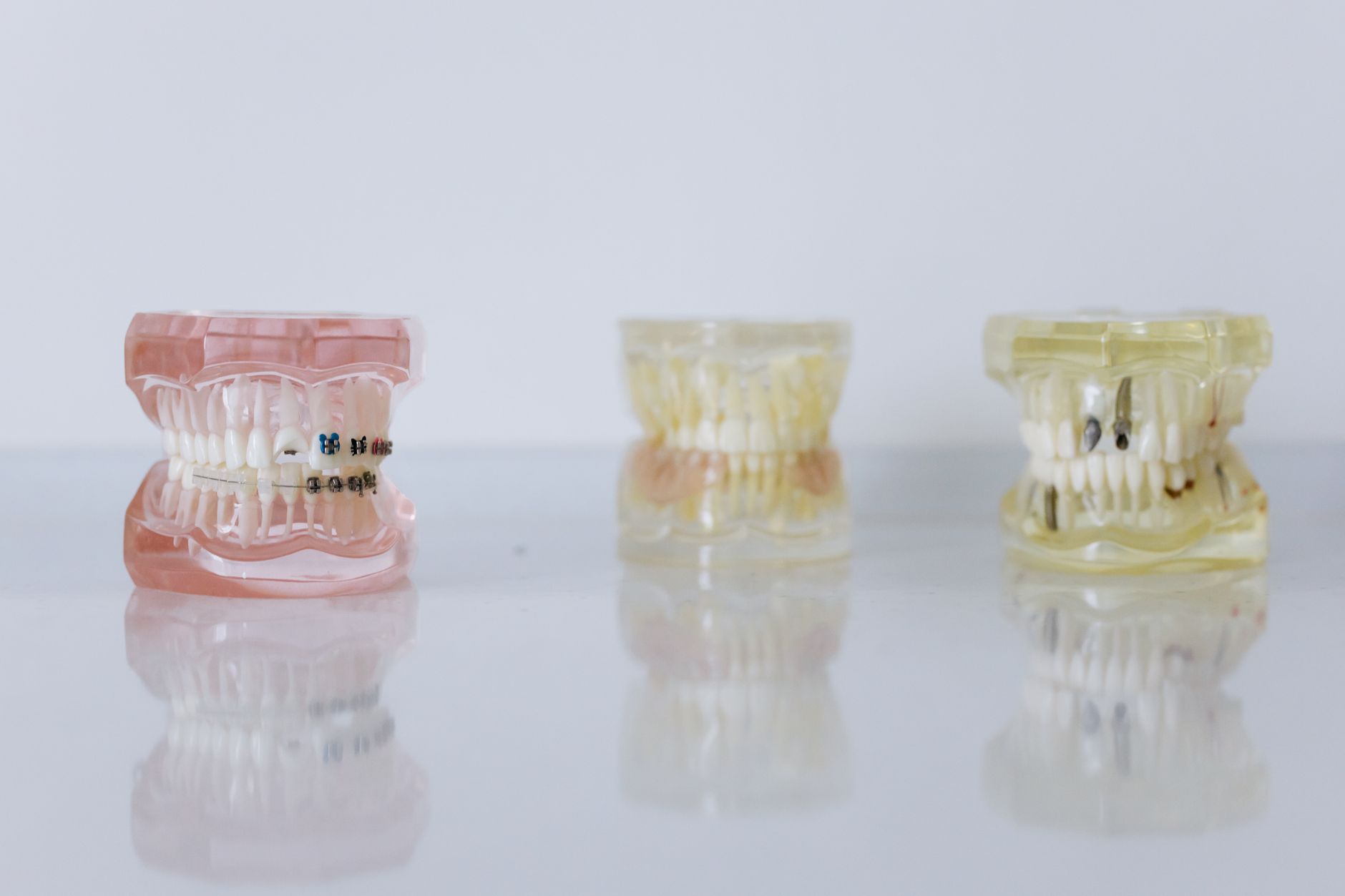 Dental Implants - Denwest Dental Clinic Dental Implants in Woodbridge, Ontario - Avoid Wisdom Tooth Pain: Removal Guide for Woodbridge, Ontario