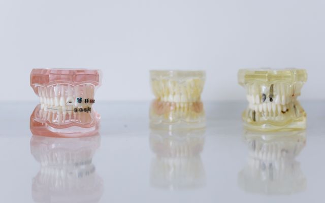 Full mouth rehabilitation dental models and prosthetics at Smile Point Ranikuthi
