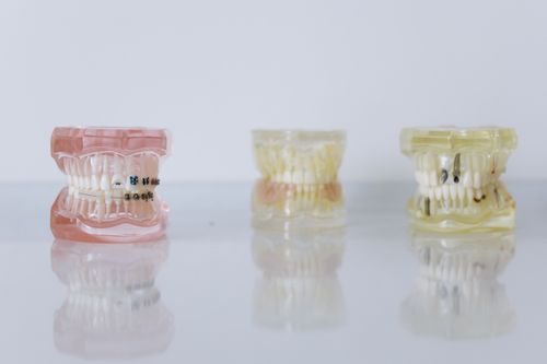 Free Close-up of dental models displaying braces and dentures for orthodontic education. Stock Photo