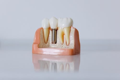 Gratuit Imagine de stoc gratuită din a închide, dinți, implant dentar Fotografie de stoc