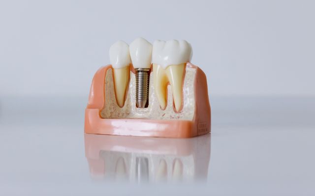 Dental implant model showing titanium screw placement at Smile Point Kolkata