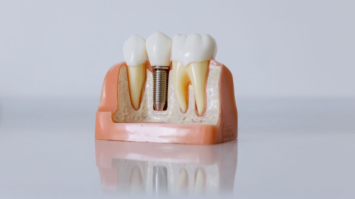 Detailed dental implant model showcasing teeth structure for educational purposes.