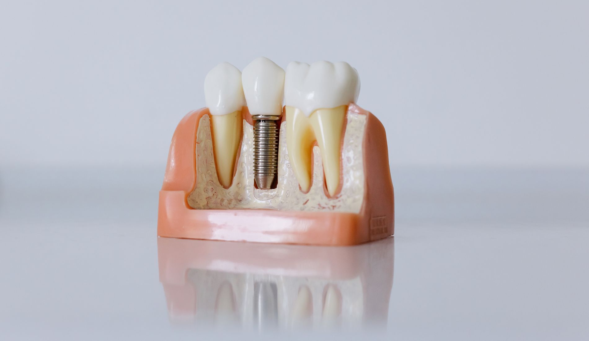 Dental Crowns — PFM & Zirconia