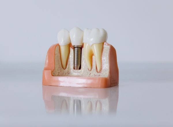 PFM vs Zirconia crowns: a Lahore patient’s guide
