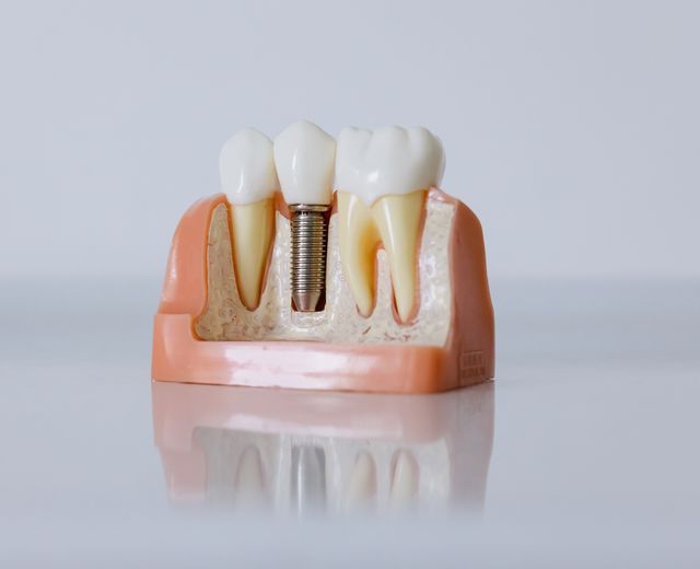 After crowns at Ohud Dental, Lahore