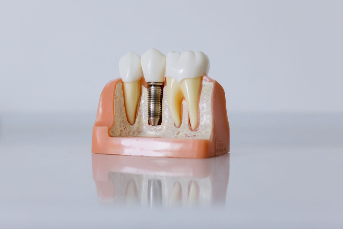 Dental implant model showing tooth replacement