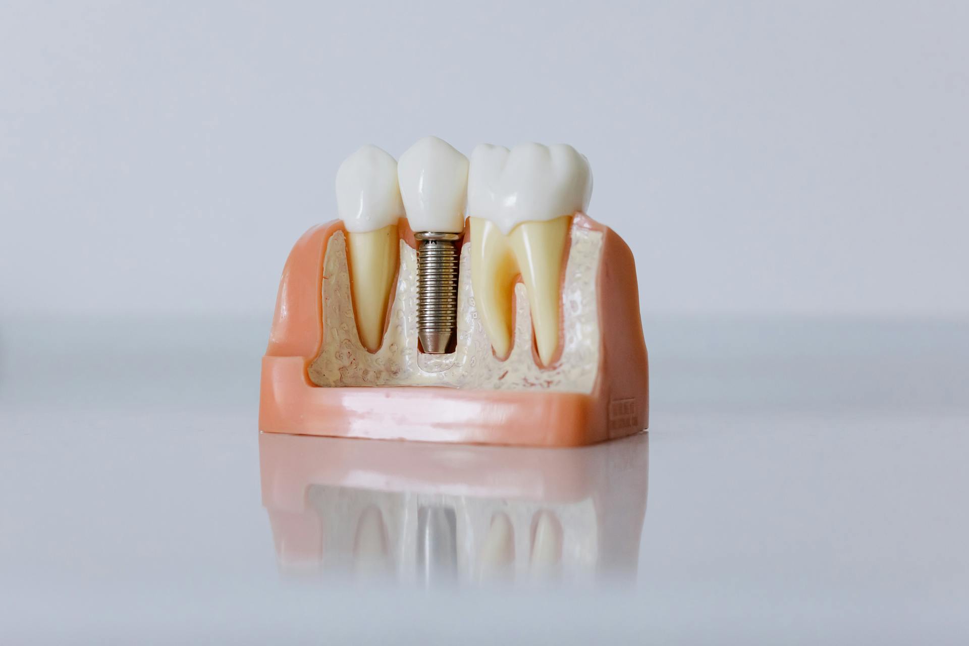 Close-Up Shot of Dental Implant Model