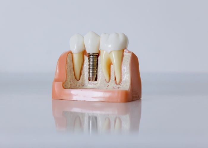 Dental Implant Package
