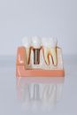 Close-Up Shot of Dental Implant Model