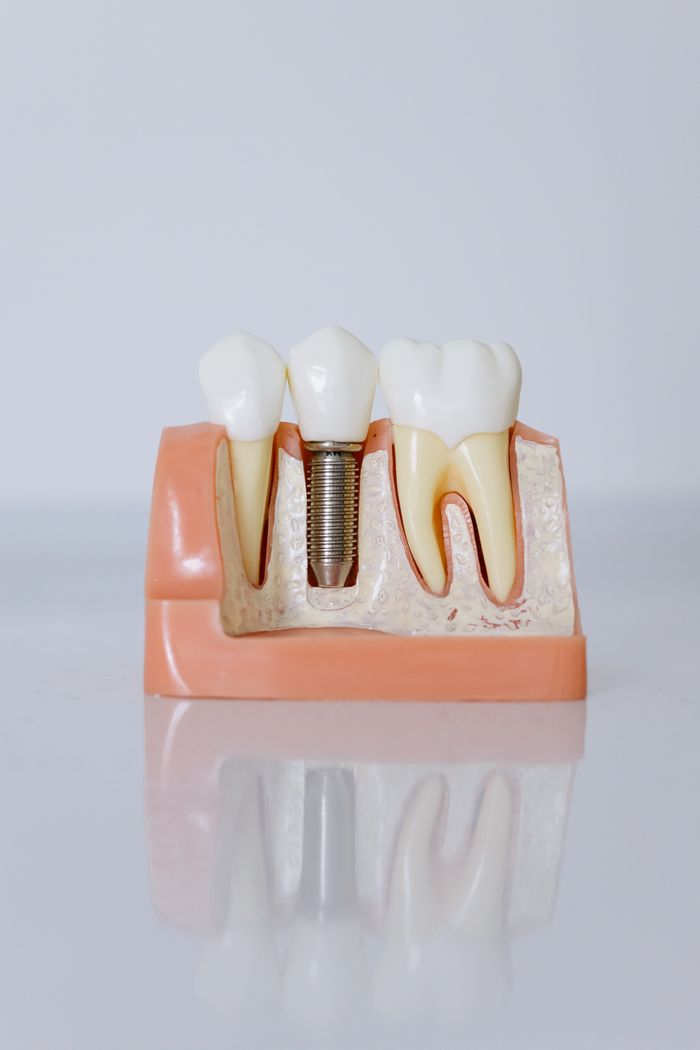 Dental implant model