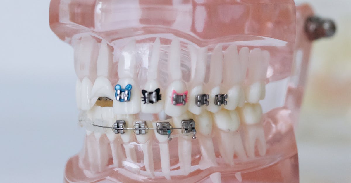 How to get off your braces faster