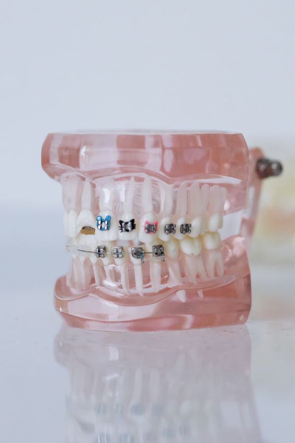 Primer plano de brackets y dentaduras postizas de alta calidad