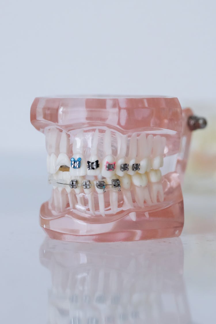 Close-Up Shot Of Dentures With Braces