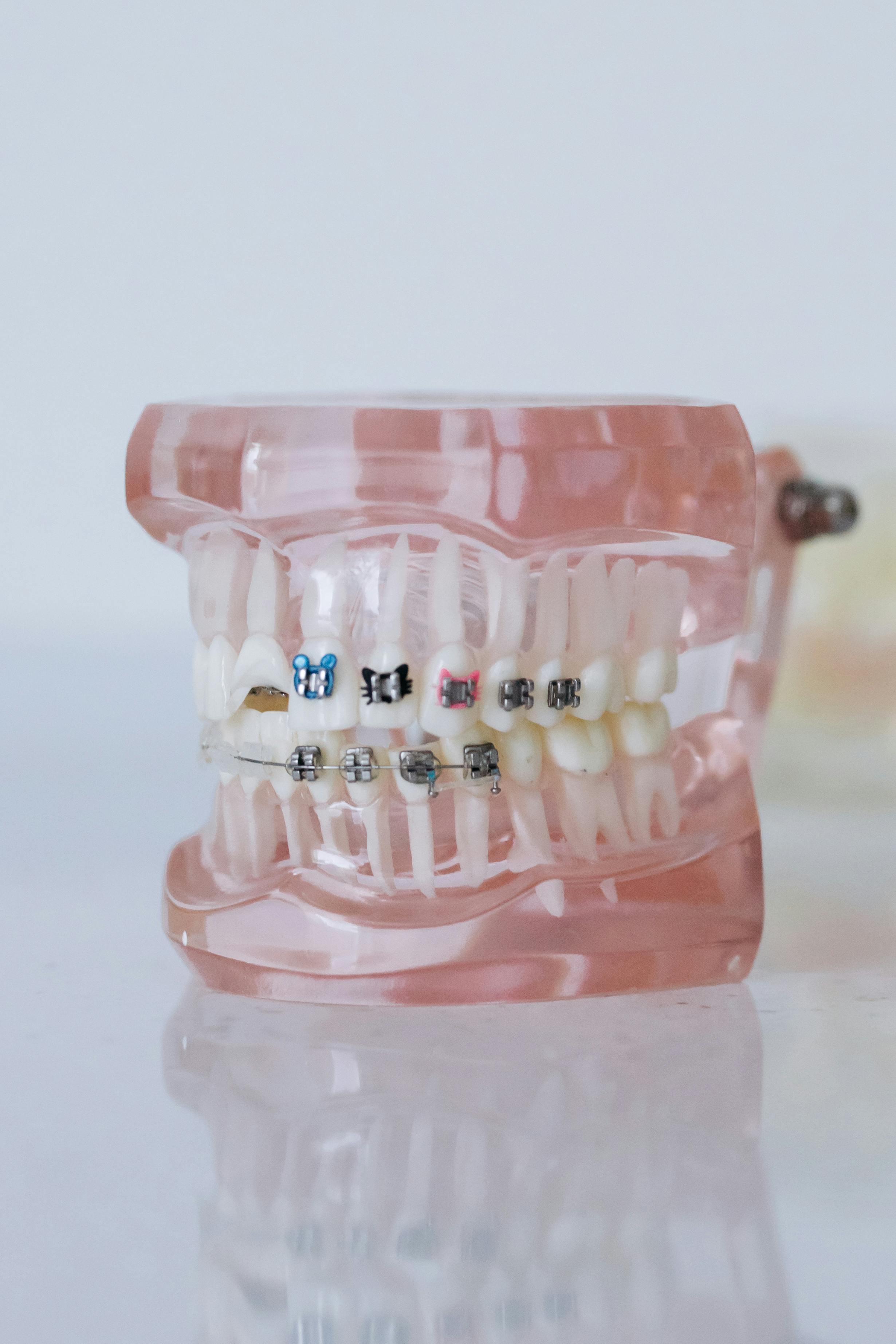 60+ Clip On Braces For Teeth Stock Photos, Pictures & Royalty-Free