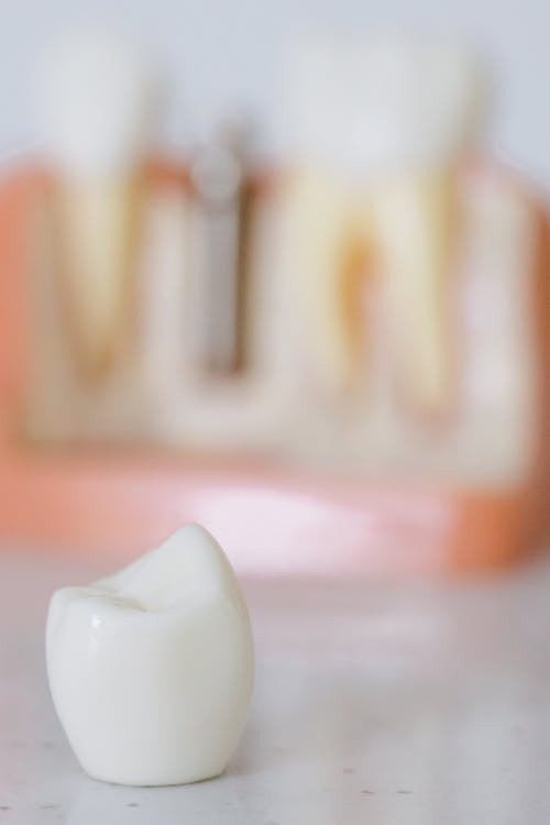 Free Close Up Photo of an Implant Tooth Stock Photo